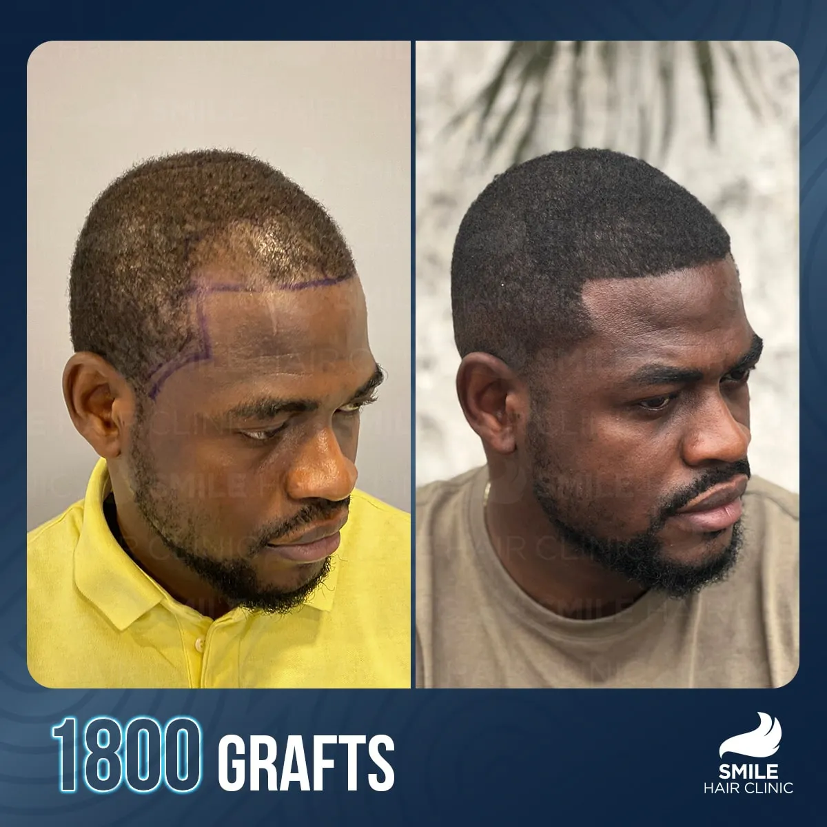Hair transplant transformation result