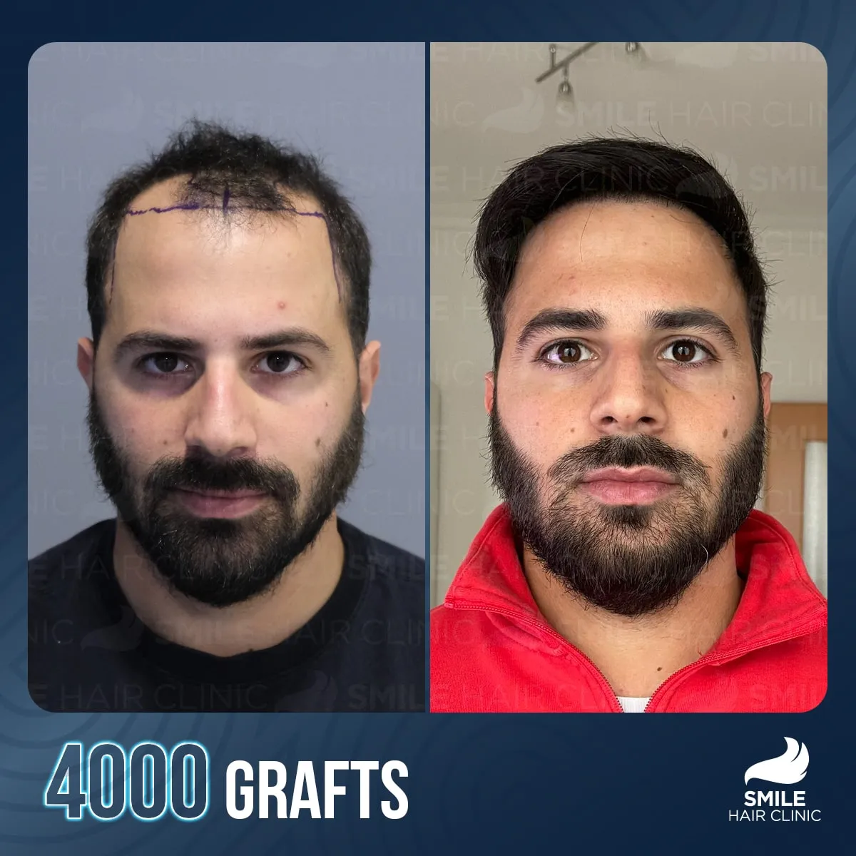Hair transplant transformation result