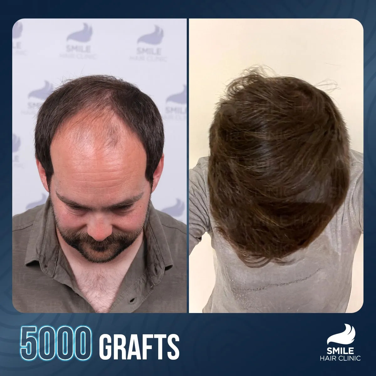 Hair transplant transformation result
