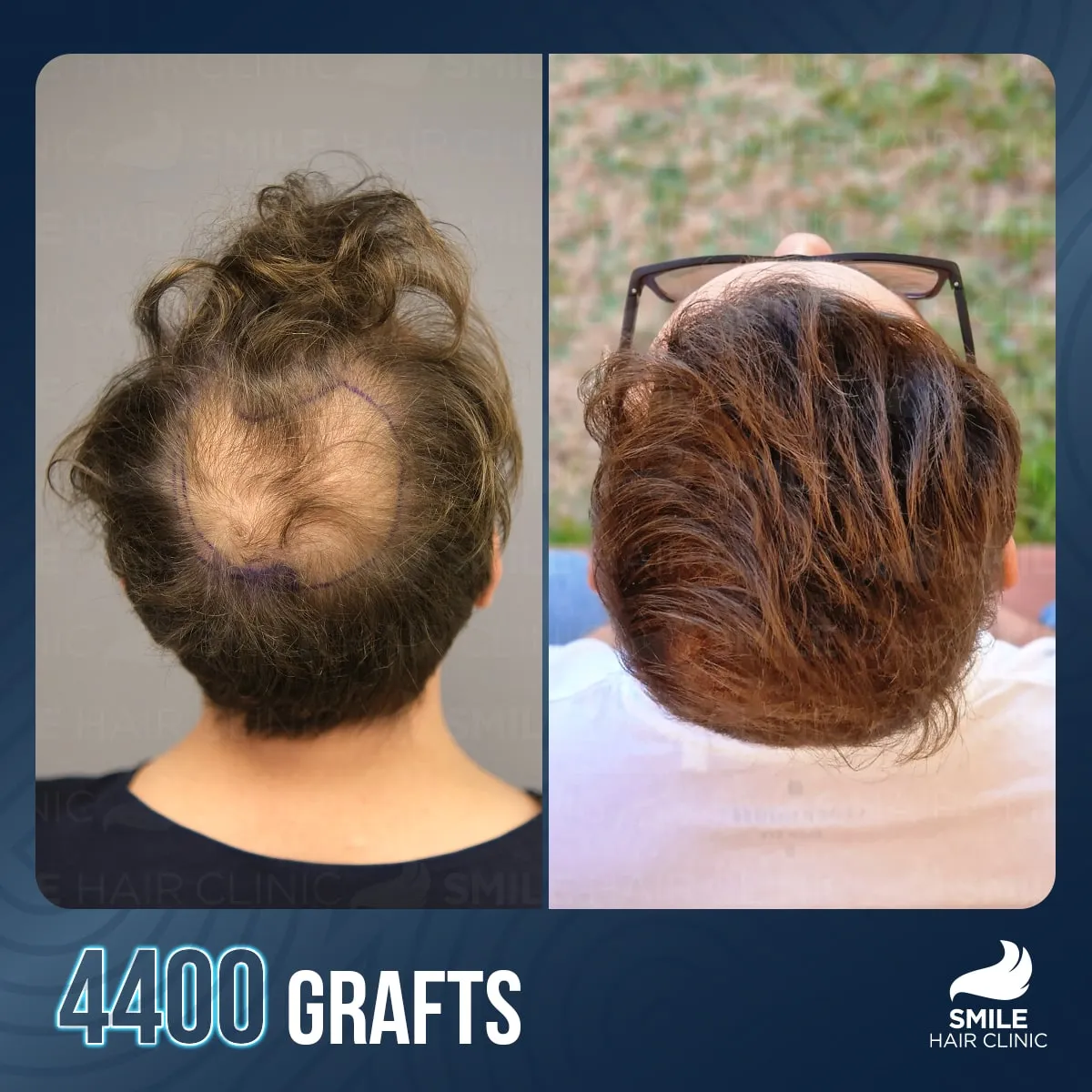 Hair transplant transformation result