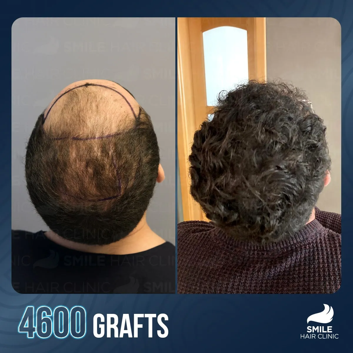 Hair transplant transformation result