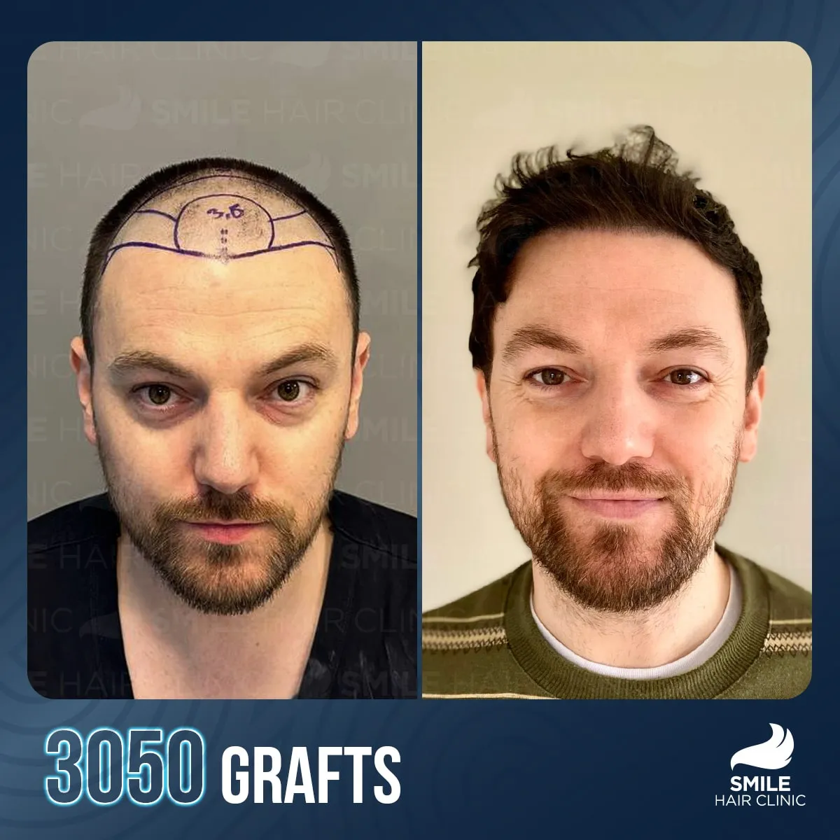 Hair transplant transformation result