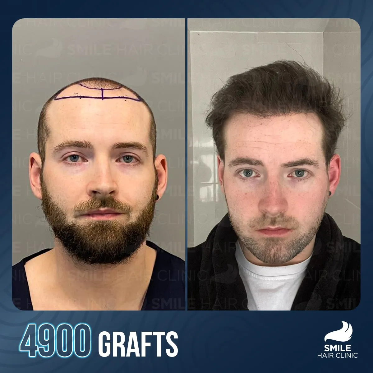 Hair transplant transformation result