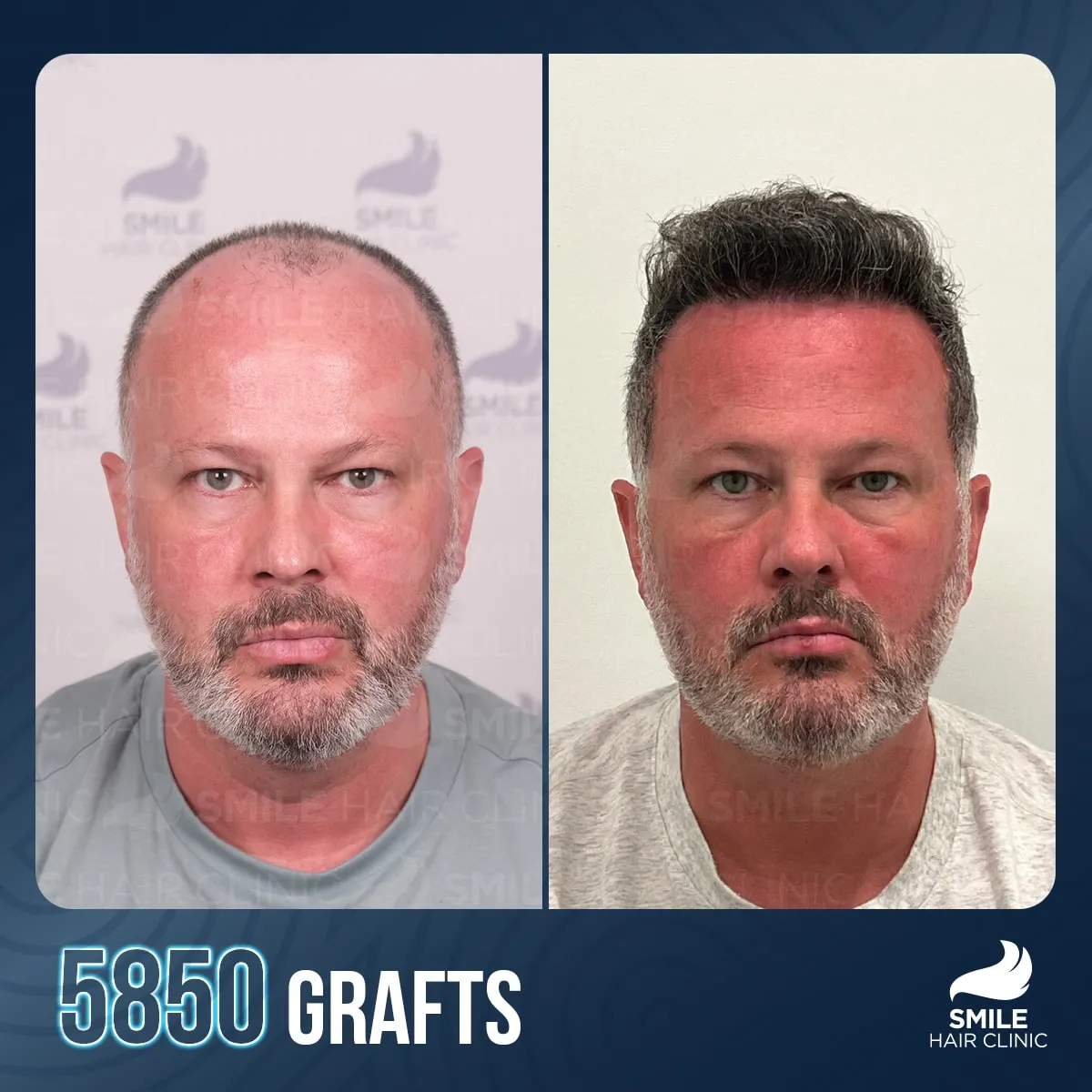 Hair transplant transformation result