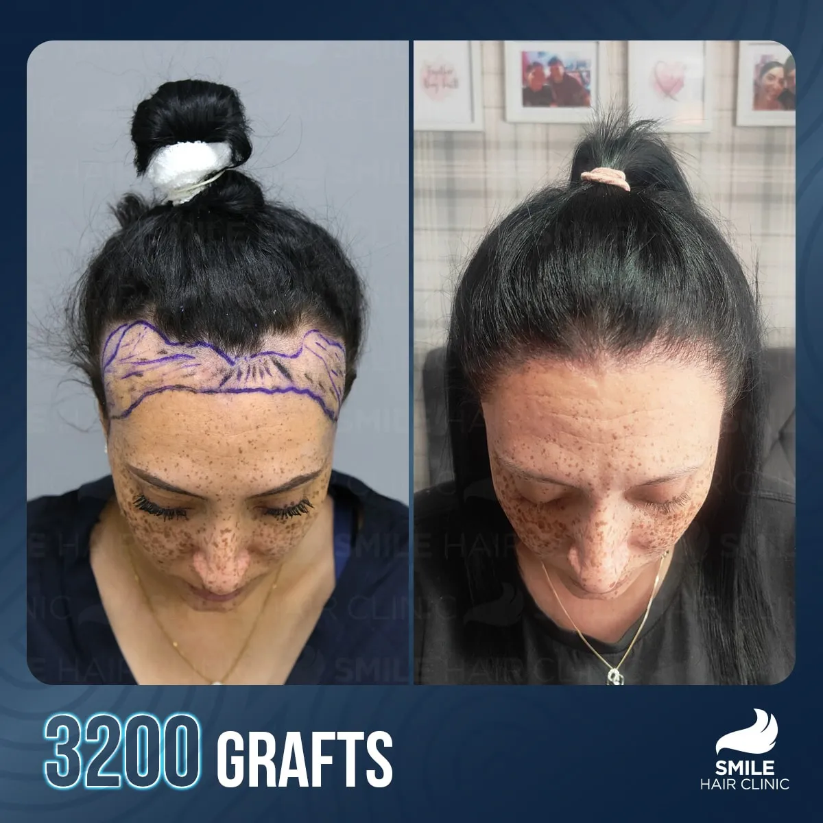 Hair transplant transformation result