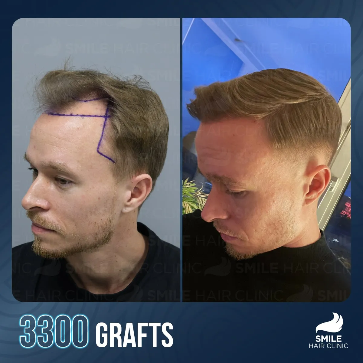 Hair transplant transformation result