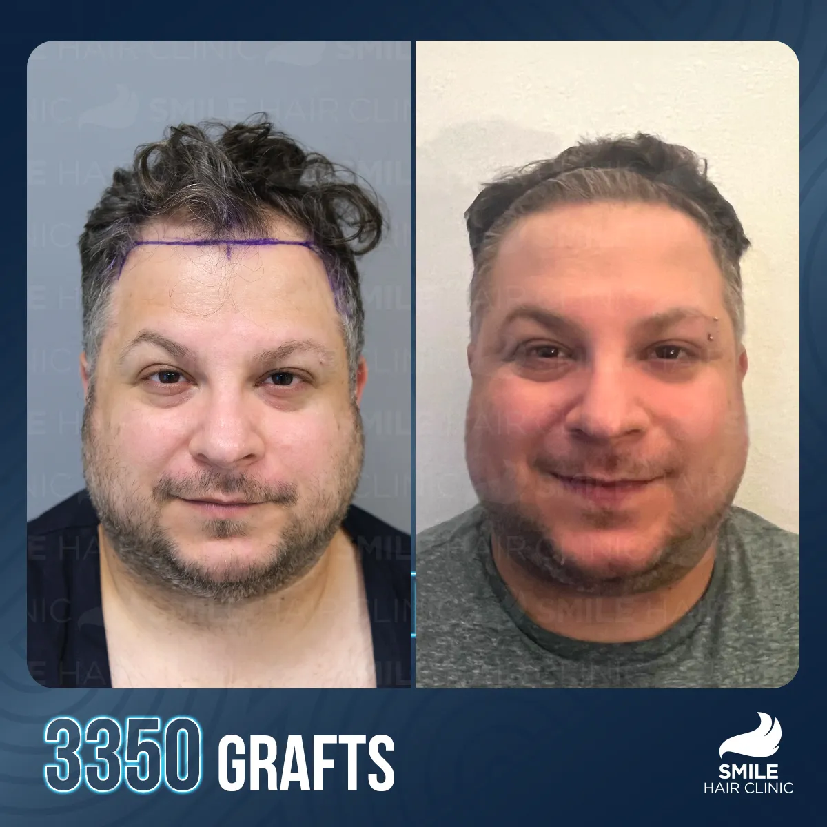 Hair transplant result 1