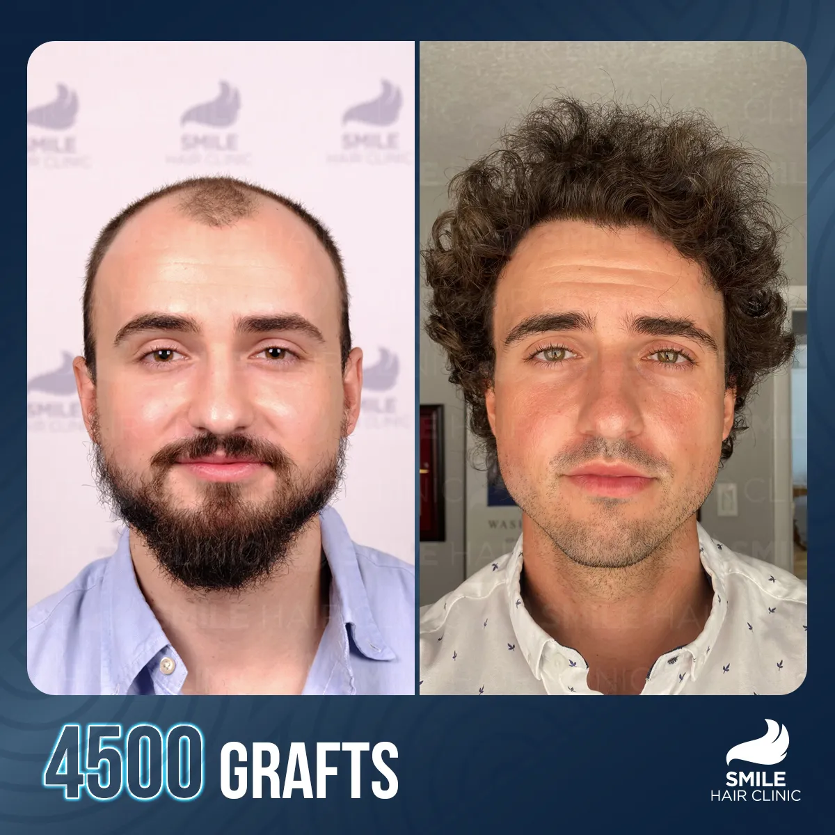 Hair transplant result 10