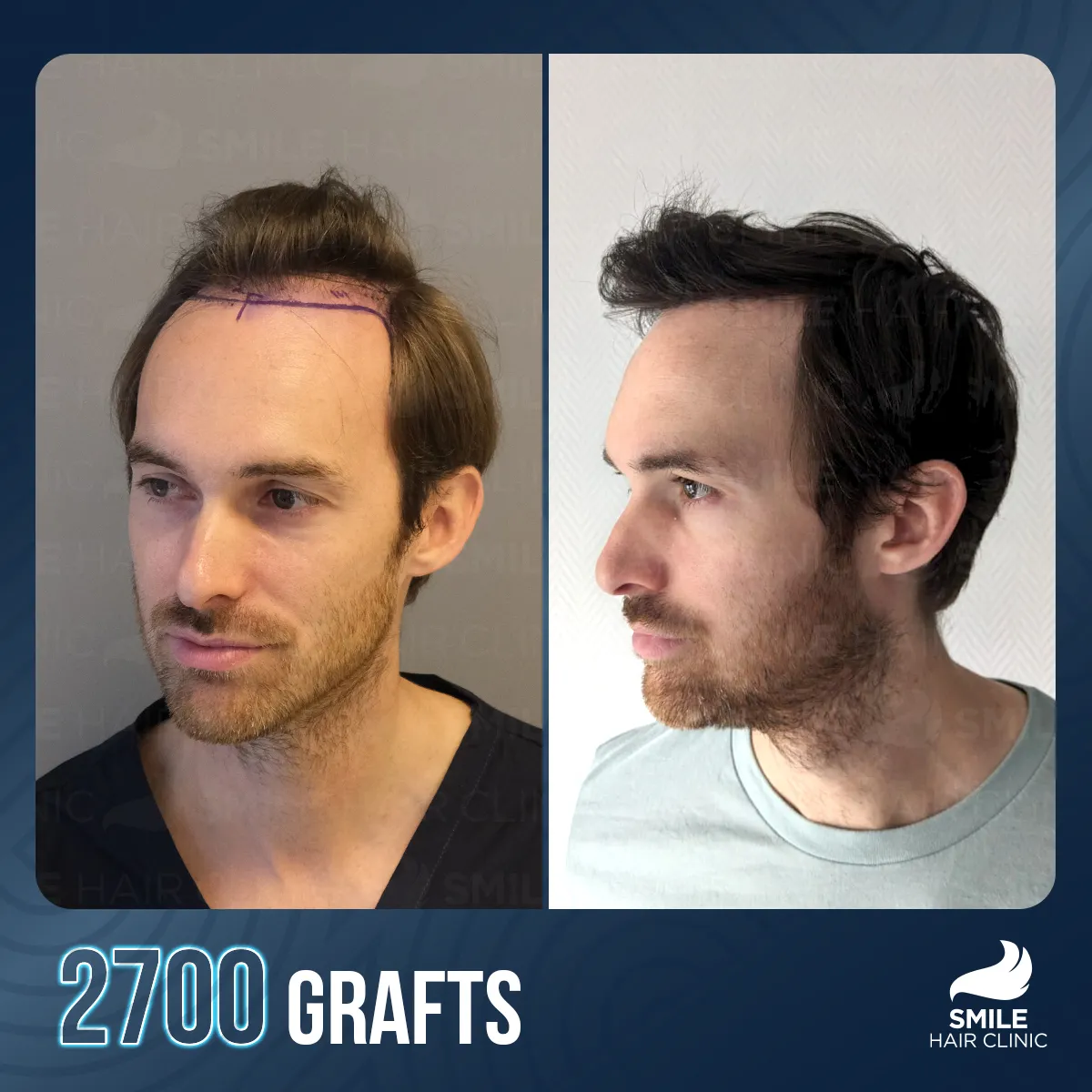 Hair transplant result 12