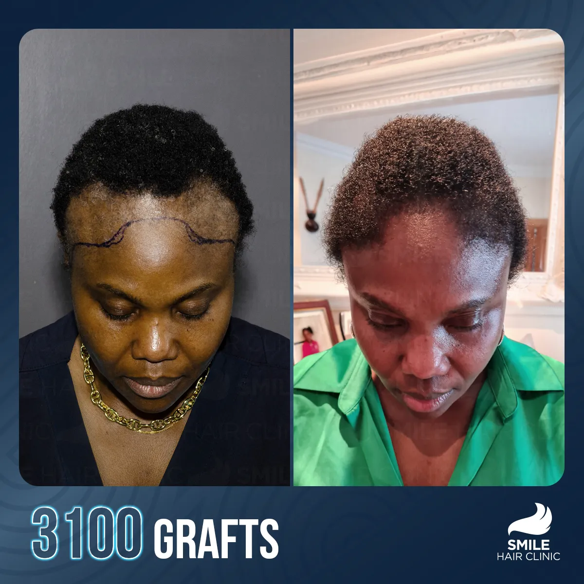 Hair transplant result 13