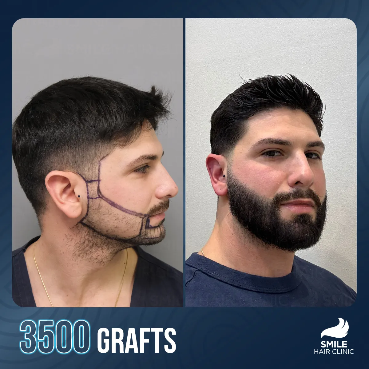 Hair transplant result 14