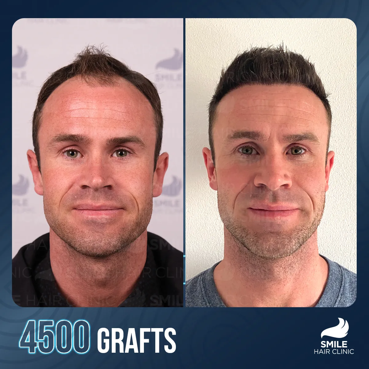 Hair transplant result 2
