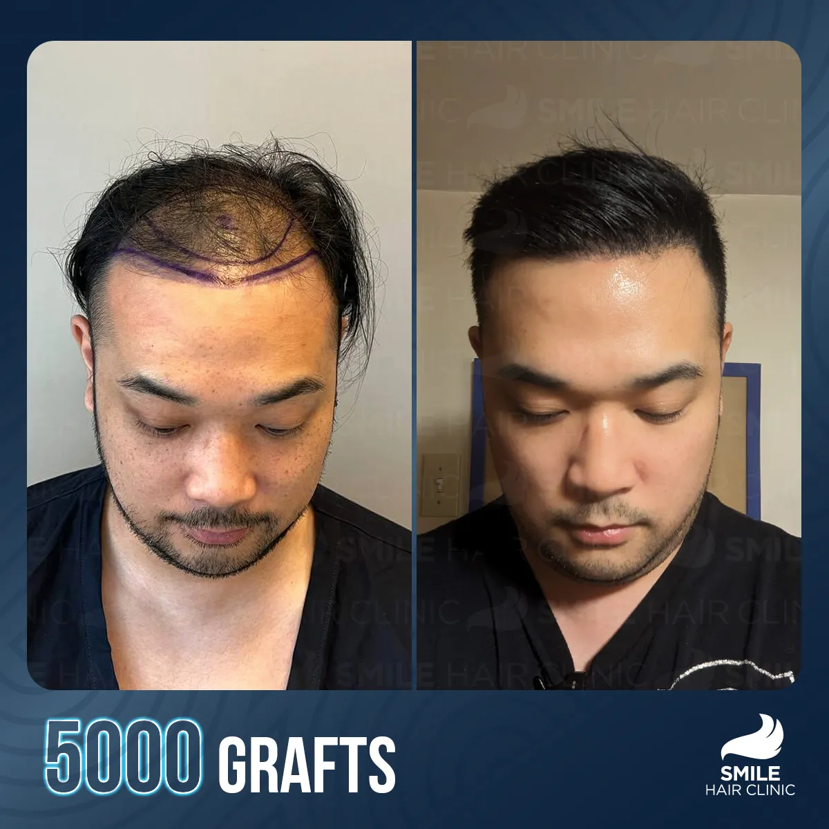 Hair transplant result 3