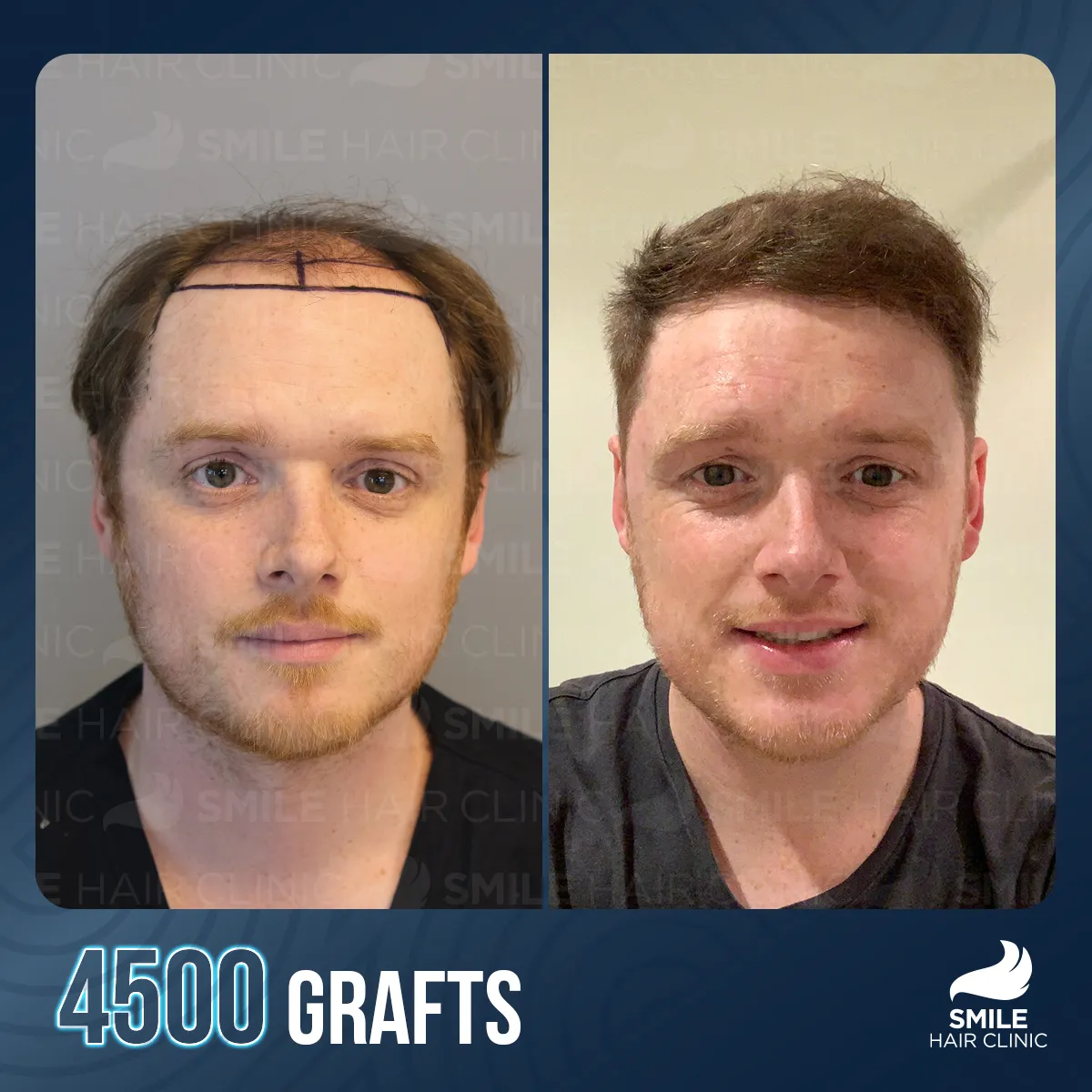Hair transplant result 4