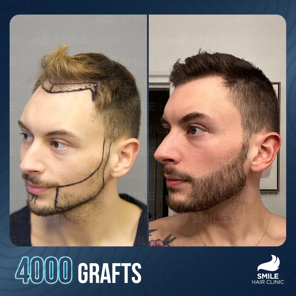 Hair transplant result 5