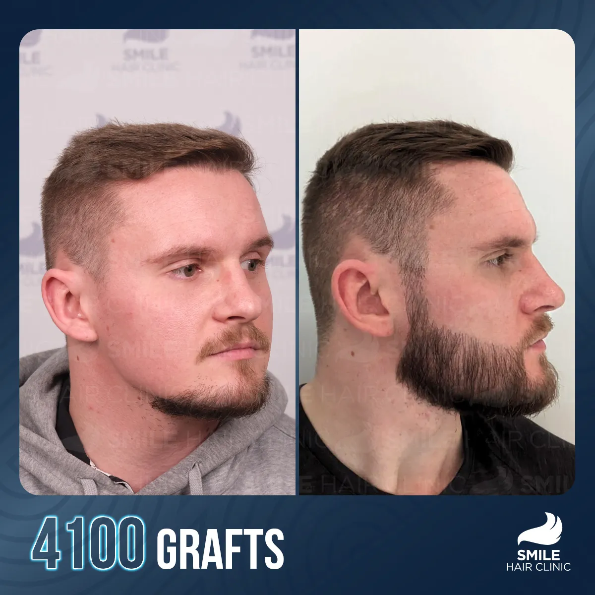 Hair transplant result 6
