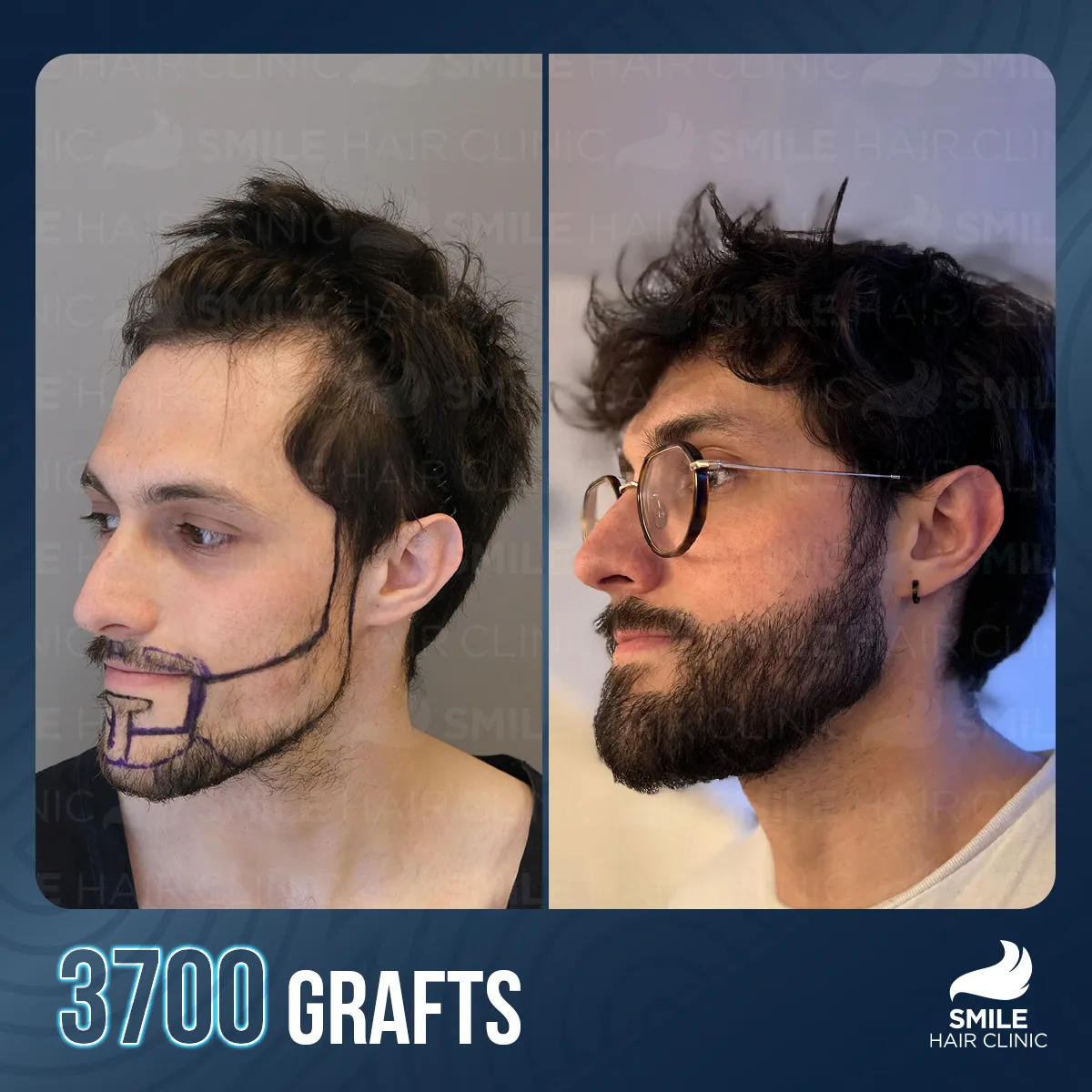 Hair transplant result 7
