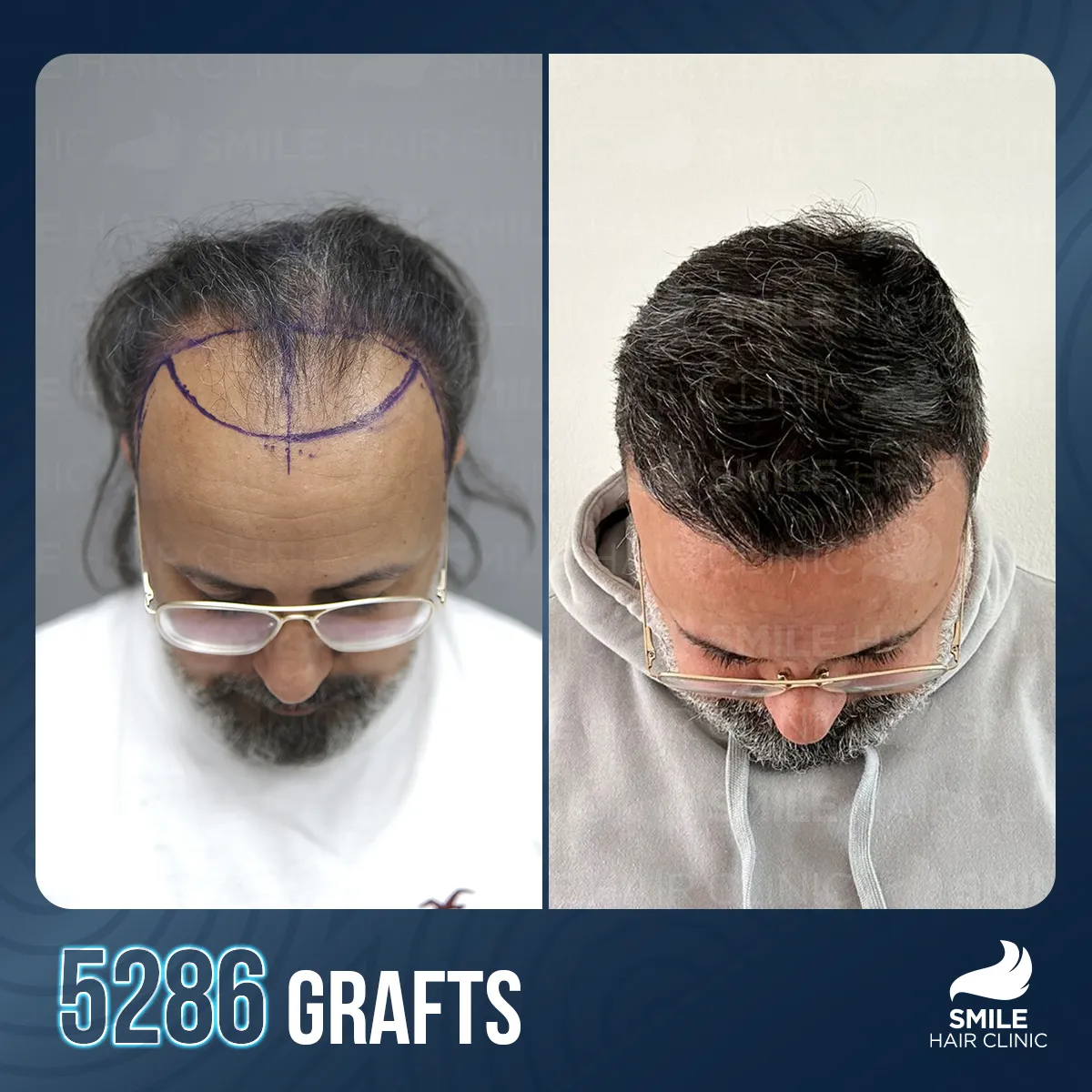 Hair transplant result 8